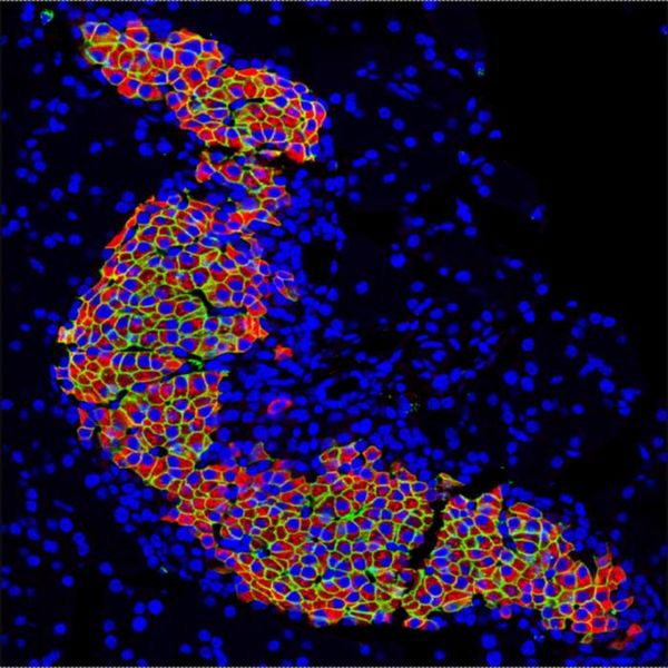 Gendefekte bei Diabetes   Ein Forscherteam in Barcelona hat einen wichtigen Mechanismus im Gen HNF1A entdeckt, der das Risiko für Typ-2-Diabetes erhöhen kann. Mutationen in diesem Gen sind bekannt dafür eine seltene Form von Diabetes, zu verursachen. Aber auch kleinere Veränderungen desselben Gens können viele Menschen anfälliger für Typ-2-Diabetes machen.  Das HNF1A-Gen spielt eine zentrale Rolle in den Insulin-produzierenden β-Zellen der Bauchspeicheldrüse. Wenn dieses Gen in den β-Zellen ausgeschaltet wird, funktioniert die Regulation von über hundert anderen Genen nicht mehr richtig, die für die Insulinproduktion wichtig sind.  Das Bild zeigt Insulin-positive β-Zellen (grün), die HNF1A (rot) anzeigen und somit dessen Anwesenheit in verschiedenen endokrinen Zelltypen bestätigen; DAPI (blau) markiert die Zellkerne. Hier gehts zur Originalmeldung Wissenschaftsbild des Tages vom 12.8.2025 Bildquelle: Miguel Angel Maestro Garriga/Centro de Regulación Genómica , (CC BY 4.0)   (Bild: Miguel Angel Maestro Garriga/Centro de Regulación Genómica)