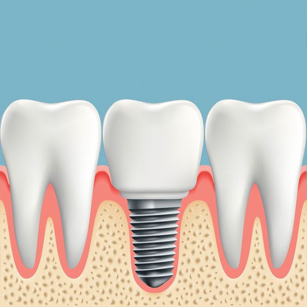 Schemadarstellung eines Implantats im Kiefer. (Trifonenko Ivan/Fotolia)