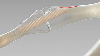 Der große Vorteil der Schraube aus Spenderknochen: Das Spendermaterial heilt vollständig in den Knochen ein - keine OP zur Metallentfernung, die Infektionsgefahr reduziert sich auf ein Minimum. (surgebright )