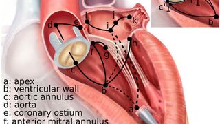 Einen mit Sensoren und Software ausgestatteten Katheter haben Wissenschafter entwickelt, der autonom in der Vene zum Herzen navigiert. (Bild: Science Robotics  24 Apr 2019:
Vol. 4, Issue 29, eaaw1977)