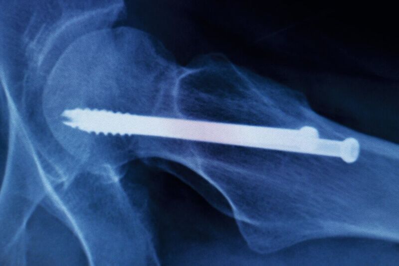 Medizinische Implantate stabilisieren beispielsweise verletzte Knochen und ermöglichen so deren Heilung.  (©edwardolive - stock.adobe.com)