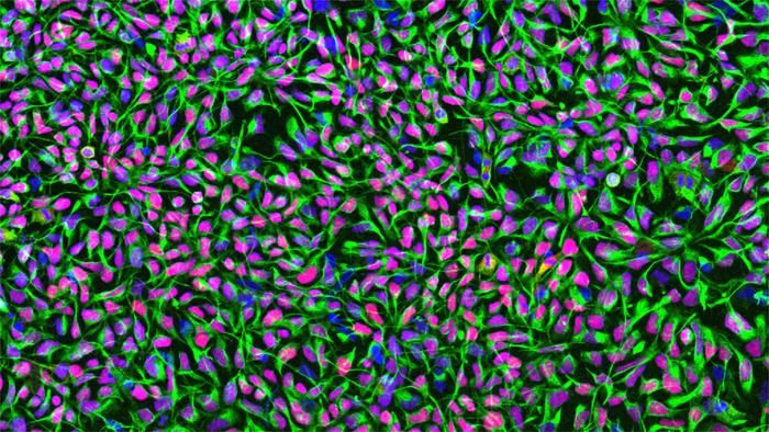 Stammzellen: Reparateur fürs Gehirn Verletzungen und Schäden im Gehirn galten lange als unheilbar, da abgestorbene Neuronen sich nicht regenerieren. Forschende der Universität Zürich haben nun herausgefunden, dass die Transplantation neuraler Stammzellen in der Lage ist, Schäden nach einem Schlaganfall in Mausgehirnen zu reparieren.  Bei den untersuchten Mäusen regenerierten sich Neuronen nach einer Stammzelltransplantation, wodurch sich die Motorik der Tiere verbesserte. Christian Tackenberg, Wissenschaftlicher Leiter im Bereich Neurodegeneration an der Universität, weist dennoch darauf hin, dass weitere Untersuchungen notwendig sind, bevor dieser Ansatz in der klinischen Praxis angewendet werden kann.  Dabei wurden die Stammzellen so hergestellt, dass sie für potenzielle Anwendungen beim Menschen geeignet sind. Erste klinische Studien, die auf ähnlichen Ansätzen beruhen, finden bereits statt, was Hoffnung auf künftige Behandlungsoptionen weckt. Tackenberg und sein Team arbeiten weiterhin daran, die Sicherheit der Methode zu erhöhen, um Risiken zu minimieren und die Durchführbarkeit zu verbessern.   Das Bild zeigt humane neurale Stammzellen in Kultur. Zellkerne sind in Blau gefärbt, das neuralstammzellspezifische Filamentprotein Nestin erscheint in Grün, und der neuralstammzellspezifische Transkriptionsfaktor Sox1 ist in Rot dargestellt.  Hier gehts zur Originalmeldung Wissenschaftsbild des Tages vom 25.9.2025  (Bild: University of Zurich)