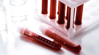 Mithilfe von Blutproben und künstlicher Intelligenz erkennt ein neues Verfahren aus Marburg, ob Infektionen durch Bakterien, Viren oder andere Faktoren verursacht sind. (Symbolbild) (Bild: 279photo - stock.adobe.com)