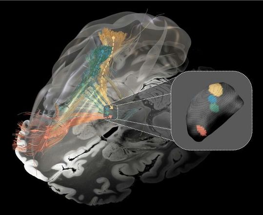 Affected brain circuits in Parkinson’s disease (green), dystonia (yellow), Tourette’s syndrome (blue), and obsessive-compulsive disorder (red). Inset: the optimal target areas for deep brain stimulation in the basal ganglia. (Source:  Charité/ Barbara Hollunder)