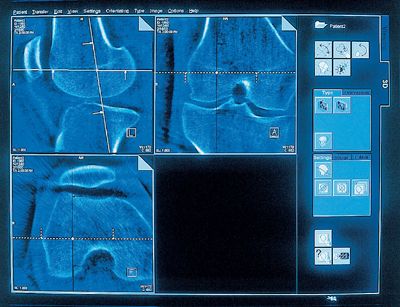 Der erste Schritt zu einem perfekten Implantat ist ein Bild mit der Darstellung des Bruchs: Bei komplizierten Knochenbrüchen leistet die Computertomographie (CT) wertvolle Dienste. Anhand der Bilddaten wählt der Arzt ein geeignetes Implantat aus und positioniert es am Computer im virtuellen Bruchbereich. Die Voraussetzung dafür ist natürlich, dass die notwendigen Daten für die Geometrie des Implantats vorliegen. Entweder hat die Klinik es auf Lager oder es wird direkt beim Hersteller geordert.
Bild: Siemens
 (Archiv: Vogel Business Media)