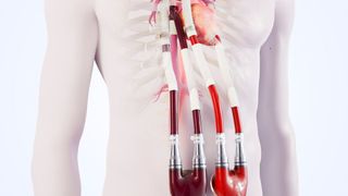 Die Venenkanüle bietet Patienten mit einem versagenden Fontan-Kreislauf die Chance, die Wartezeit auf ein Spenderherz zu überbrücken. (Berlin Heart)