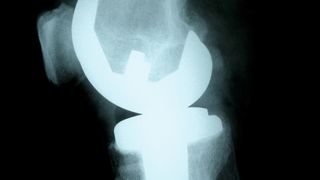 1 Auch medizinische Implantate und Prothesen müssen sicher sein und sind daher auf das Vorhandensein von Verbindungen zu untersuchen, die den Patienten gefährden können. (Bild: © Whyona - Fotolia.com)