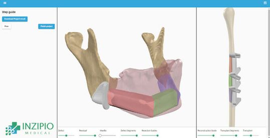 (Bild 4: Rekonstruktion des Unterkiefers durch segmentiertes mikrovaskuläres Fibulatransplantat. Aufgrund der Verwendung von digital geplanten und 3D-gedruckten Cutting Guides wird die Operationszeit reduziert und die Präzision gesteigert und damit ein gutes funktionelles und ästhetisches Ergebnis erzielt. Bild: Inzipio)