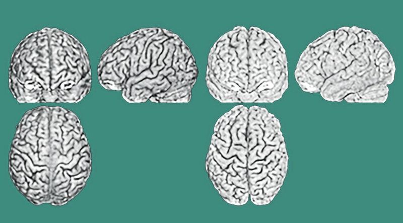 Links und rechts je drei Hirnscans (Ansichten: vorne, Seite und oben) von Zwillingen im Vergleich. Die Furchen und Wülste verlaufen bei den beiden Personen unterschiedlich. (Bild: Lutz Jäncke, UZH)