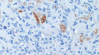 Leberzellen unter dem Mikroskop. Apoptotische Zellen sind braun gefärbt, Zellkerne blau. (Bild: HZI/Schmitz)