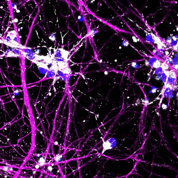 Durchbruch bei ALS  ALS, oder Amyotrophe Lateralsklerose, ist gekennzeichnet durch den Untergang von Motoneuronen im Gehirn und Rückenmark, was zu Muskelschwund und letztlich zum Tod führt. Forscher der Universität Stockholm und des UK DRI am King's College London haben mithilfe von CRISPR und Stammzellen einen gemeinsamen Nenner für Genmutationen gefunden, die ALS, eine tödliche Krankheit, verursachen.  Sie entdeckten mithilfe von CRISPR/Cas9, dass Funktionsstörungen in den Mitochondrien der Nervenzellen auftreten, bevor andere Krankheitssymptome sichtbar werden. Diese Einsicht könnte zukünftige Behandlungen maßgeblich beeinflussen, da ein tieferes Verständnis der Krankheitsmechanismen entscheidend für die Entwicklung neuer Therapien ist.  Mit CRISPR/Cas9 führten die Forscher ALS-Mutationen in menschliche Stammzellen ein, um Motoneuronen und widerstandsfähigere Interneuronen zu erzeugen. Durch Einzelzell-RNA-Sequenzierung identifizierten sie eine allgemeine Krankheitssignatur, die einzigartig für Motoneuronen ist. Bislang wurde angenommen, dass das Fehlverhalten von Proteinen, nicht aber Mitochondrienprobleme, als erstes auftritt. Neue Entdeckungen zeigen, dass die meisten Fehler durch neue toxische Eigenschaften von Proteinen verursacht werden, und die Beeinträchtigung des Mitochondrientransports in die Axone. Auf dem Bild sind die Neuronen mit Mitochondrien lila eingefärbt. Hier gehts zur Originalmeldung Wissenschaftsbild des Tages vom 22.5.2025  (Bild: Melanie Leboeuf)