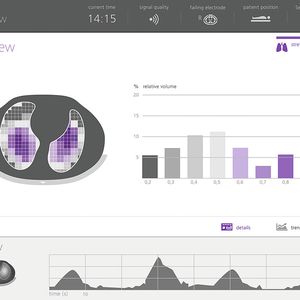 Echtzeit-Bilder der atmenden Lunge: Das EIT-System mit dem Sensor Belt erlaubt, lokale Auswirkungen der Beatmung auf das fragile Lungengewebe zu überwachen.