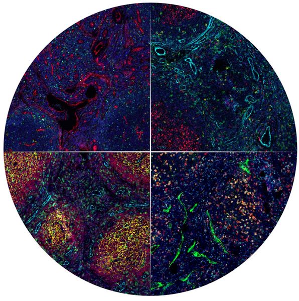 Analyse komplexer Gewebebilder   Dank moderner Bildgebungsverfahren ist es inzwischen möglich, mit nur einer Gewebeprobe zu ermitteln, welche Zellen im Gewebe vorhanden sind und wie diese organisiert sind.  Die multiparametrische Mikroskopie erfasst zahlreiche Proteine in einer einzigen Gewebeprobe gleichzeitig, oben im Bild etwa eine Lymphombiopsie. So macht sie verschiedene Zelltypen und Gewebestrukturen sichtbar.   Nun hat ein interdisziplinäres Forschungsteam der Heinrich-Heine-Universität Düsseldorf (HHU), des Universitätsklinikums Düsseldorf (UKD) und des Europäischen Laboratoriums für Molekularbiologie (EMBL) eine Software entwickelt, die bei der Analyse solcher Ergebnisse künftig unterstützen soll. Dazu wertet die Software spatialproteomics die Daten systematisch und reproduzierbar aus.     Hier geht‘s zur Originalmeldung Wissenschaftsbild des Tages vom 25.8.2026  (Bild: UKD)