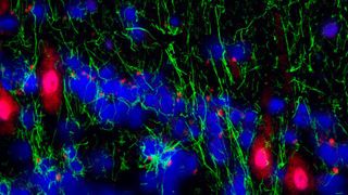 Immunfluoreszenzaufnahme aus der Kleinhirnrindenregion von bipolaren Patienten, die Proteine von humanen Herpesviren (rot) in Purkinje-Neuronen zeigen. Astrozyten sind grün gefärbt. (AG Prusty/Uni Würzburg)