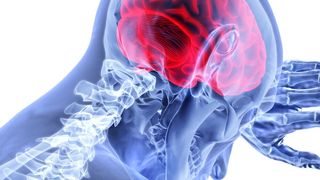 Brain metastases are the most common type of tumor that affects the brain, occurring in 20-40 % of all systemic cancers. (Public Domain)