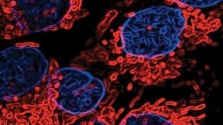 Krebszellen vor der Behandlung,  (Bild: University of Alberta)