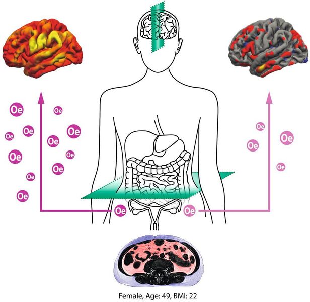 Erhöhtes Organfett (Scan unten) beschleunigt die Alterung von Gehirnnetzwerken. Östradiol (Oe) scheint das Gehirn von Frauen während der Lebensmitte vor strukturellen Schäden (rechts oben). (MPI CBS)