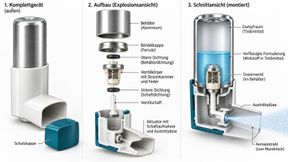 Aufbau eines Druckgas-Dosieraerosols: Im Behälter steht die Formulierung mit verflüssigtem Treibmittel dauerhaft in Kontakt mit Dosierventil, Feder und Dichtungen; der Aktuator führt den Sprühstoß zum Mundstück. (KI-generiert / Redaktion Devicemed)