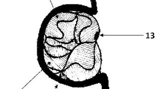 Ein Implantat zur Behandlung von Aneurysmen. (DPMA)