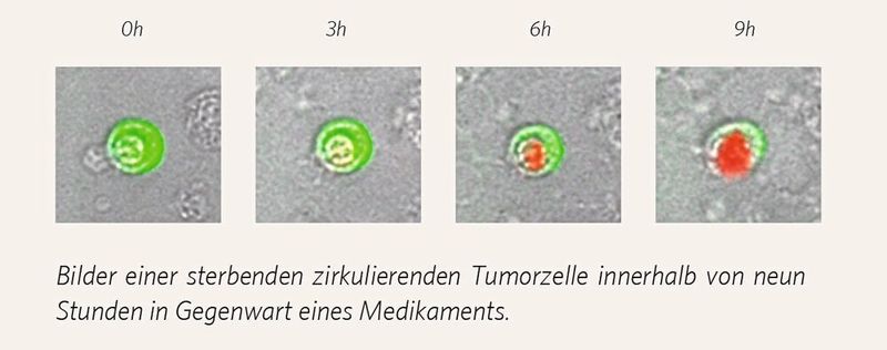 Abb. 4: Therapeutische Wirkstofftestung. Grün markiert die EpCAM-Moleküle. Der rote Farbstoff zeigt die Auflösung des Zellkerns und damit das Absterben der Zelle an. Das Medikament wirkt und senkt die Tumoraktivität. (Simfo)
