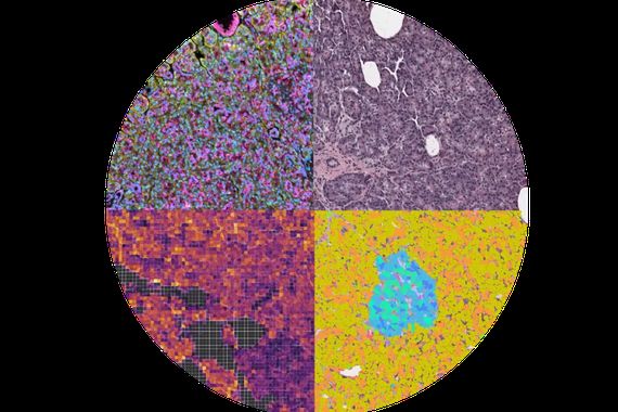 Zellatlas der Bauchspeicheldrüse


Ein internationales Forschungsteam unter Koordination des Berlin Institute of Health in der Charité (BIH) hat den bislang umfassendsten Einzelzell-Atlas der menschlichen Bauchspeicheldrüse erstellt. Dazu analysierten die Forschenden mehr als vier Millionen Zellen und Zellkerne aus Gewebeproben von 57 Spendenden.

Der Atlas umfasst verschiedene Entwicklungs- und Krankheitsstadien des Pankreas: von der fetalen Entwicklung über gesundes Gewebe im Erwachsenenalter bis hin zu Proben von Menschen mit Typ-2-Diabetes. Mithilfe modernster Einzelzell- und Multiomics-Technologien konnten die Forschenden die Genaktivität, epigenetische Regulation und räumliche Organisation der Zellen mit bisher unerreichter Detailgenauigkeit untersuchen.
Das Bild zeigt exemplarische Ausschnitte von multimodalem Kartierung des Pankreas (Protein, Durchlichtfärbung, Zelltypen, Gensignaturen)


Hier geht‘s zur Originalmeldung
Wissenschaftsbild des Tages vom 1.9.2026
 (Bild: BIH Charité)
