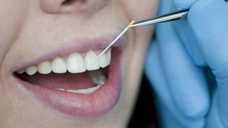 Mit sterilen Papierspitzen löst der Zahnarzt die Bakterien vom Zahn. (Bild: Fraunhofer IZI)