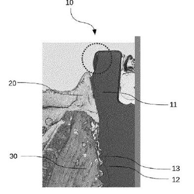 Dentalimplantat (Bild: Zircon Medical IP Box AG/DPMA)
