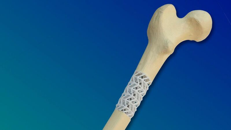 The Scabaego project scaffold can be customized to fit any size of long bone. With the help of a CT scan of the bone, the scaffold can be tailor-made using 3D printing.