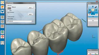 3d_cerec_teeth_model ()