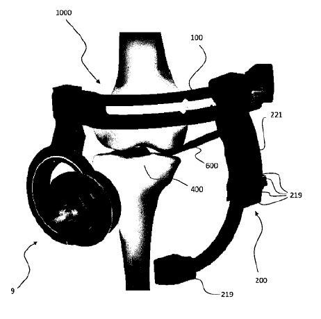 Positioniervorrichtung für die Versorgung einer Knochenfraktur mittels Knochenschrauben(Bild:  OT Medizintechnik GmbH/DPMA)