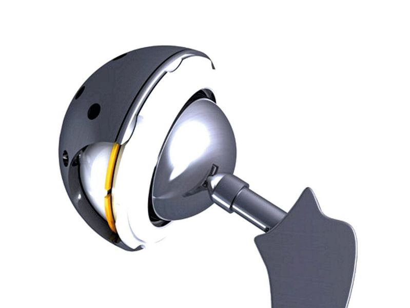 Einlagige Spirolox-Ringe bilden in künstlichen Hüftgelenken die Verbindung zwischen innerer und äußerer Gelenkschale.  (Bild: TFC/Smalley)