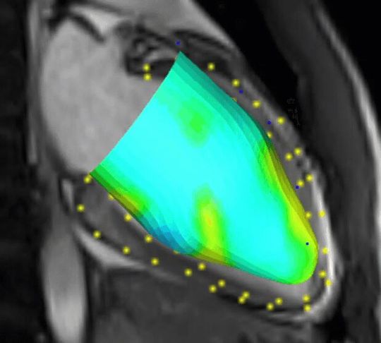 Cardiac MRI of a patient complaining of chest pain after a viral upper respiratory tract infection. A cardiac MRI scan reveals active inflammation of the heart and impaired cardiac function. Cardiac MRI of a patient complaining of chest pain after a viral upper respiratory tract infection. A cardiac MRI scan reveals active inflammation of the heart and impaired cardiac function.
