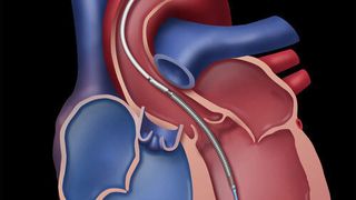 Lage des Pumpsystems im Herzen: Die Pumpe fördert bis zu 5 l Blut pro Minute. Treibende Kraft ist ein kleiner bürstenloser DC-Motor von FAULHABER, der perfekt auf diese Anwendung ausgelegt wurde. (ABIOMED)