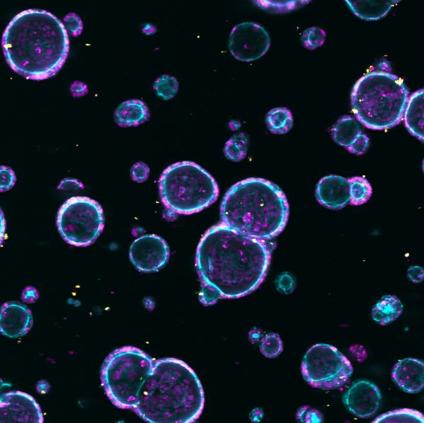 Tumor-Modell für Darmkrebs   Es sind Miniaturmodelle von Darmkrebstumoren, die Forscher vom Deutschen Krebsforschungszentrum (DKFZ) und von der Medizinischen Fakultät Mannheim der Universität Heidelberg Miniaturmodelle in ihren Laboren züchten. Mit diesen so genannten Organoiden wollen sie die personalisierte Medizin voranbringen. Denn die Organoide lassen sich aus Gewebeproben von Tumoren direkt von den Patienten züchten. Die Tumor-Nachbildungen können Forscher dann verschiedenen Medikamenten aussetzen und so die bestmögliche Therapie für den jeweiligen Betroffenen einstellen.  Hier gehts zur Originalmeldung Wissenschaftsbild des Tages vom 21.6.2022 (N. Rindtorff, J. Betge / DKFZ, UMM)