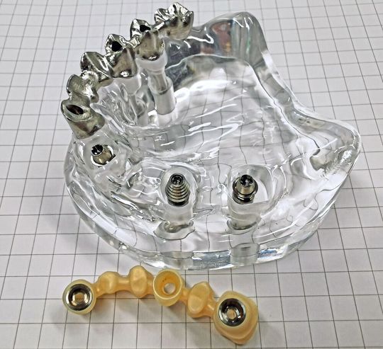 Transparentes Kiefermodell mit Implantaten, Abutment und gefrästem Zahnersatz aus Metall (oben) bzw. Zirkon-Keramik (unten). Transparentes Kiefermodell mit Implantaten, Abutment und gefrästem Zahnersatz aus Metall (oben) bzw. Zirkon-Keramik (unten).