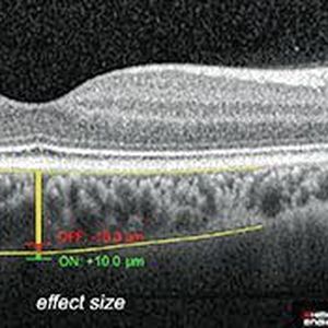 (Schaeffel/Forschungsinstitut für Augenheilkunde, Universitätsklinikum Tübingen)