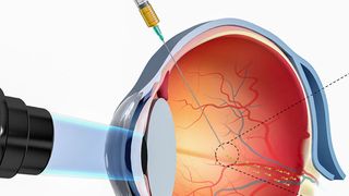 Nanoroboter werden ins Auge injiziert. (Ausschnitt) (MPI für Intelligente Systeme)