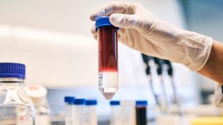Bei der adoptiven T-Zell-Therapie werden patienteneigene Immunzellen (T-Zellen) aus dem Blut isoliert und im Labor therapiespezifisch modifiziert und vermehrt. Anschließend werden sie den Patienten per Infusion wieder zugeführt und zerstören Tumorzellen. (Bild: Anna Schroll/Leibniz-HKI)