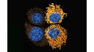 Krebszellen verändern die Form ihrer Mitochondrien (gelb), in saurer Umgebung. Das zusammengesetzte Bild zeigt zwei Zellen unter neutralem pH-Wert (l.) im Vergleich zu einer sauren Umgebung (r.), in der die Mitochondrien längliche Netzwerke bilden.  (Bild: Groessl / DKFZ)