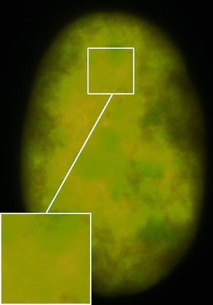 3 Kern einer menschlichen Krebszelle, in der zwei Kernproteine (Histon H2A) sowie ein Chromatin Remodellierungsprotein (SnfH2) mit zwei unterschiedlichen Typen fluoreszierender Proteine markiert sind. (Archiv: Vogel Business Media)