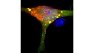 Nervenzelle mit gestörtem S1P-Abbau: Die gelb-orange markierten Müllsäcke haben sich nicht geschlossen, sondern sind durchlässig.  (© AG van Echten-Deckert/Uni Bonn)