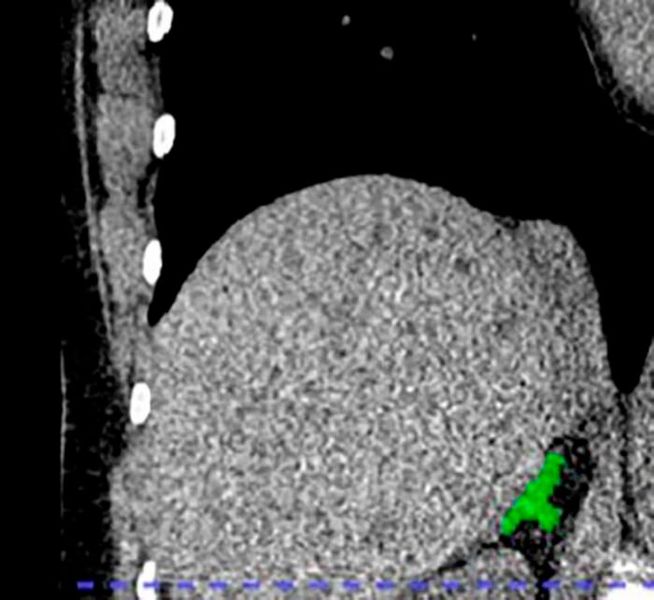 Right adrenal automated 2D segmentation in chest CT. (Source: Elena Ghotbi, M.D., and RSNA)