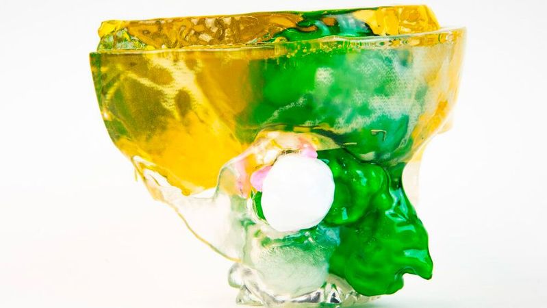 Patientenspezifisches 3D-gedrucktes anatomisches Modell mit großem Tumor in der rechten Nasenhöhle. Die Patientenscandaten wurden mit der Software von Axial3D für den 3D-Druck aufbereitet und anschließend mit einem 3D-Drucker von Stratasys additiv gefertigt.