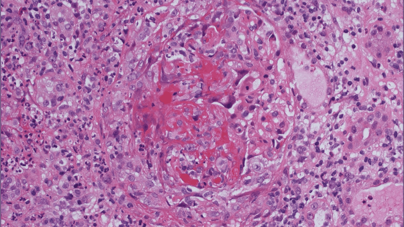 Der Gewebeschnitt zeigt Schäden der feinen Blutgefäße eines Nierenkörperchens sowie eine ausgeprägte Entzündungsreaktion in der Umgebung. Beides sind typische Folgen einer Vaskulitis.(Bild:  © Institut für Pathologie, Charité – Universitätsmedizin Berlin)