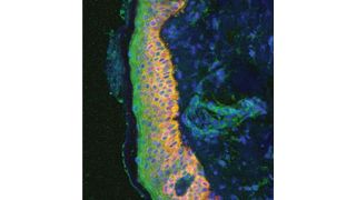 Die gemeine Schuppenflechte, auch Psoriasis vulgaris genannt, ist eine entzündliche Hautkrankheit. (Helmholtz Zentrum München)