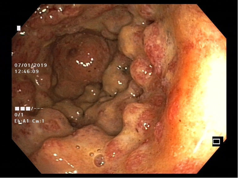 Endoskopische Aufnahme einer Dickdarmschleinhaut mit Colitis ulcerosa.  (© Pascal Juillerat, Universität Bern )