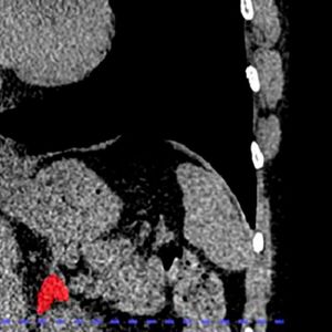 Left adrenal automated 2D segmentation in chest CT.(Source:  Elena Ghotbi, M.D., and RSNA)