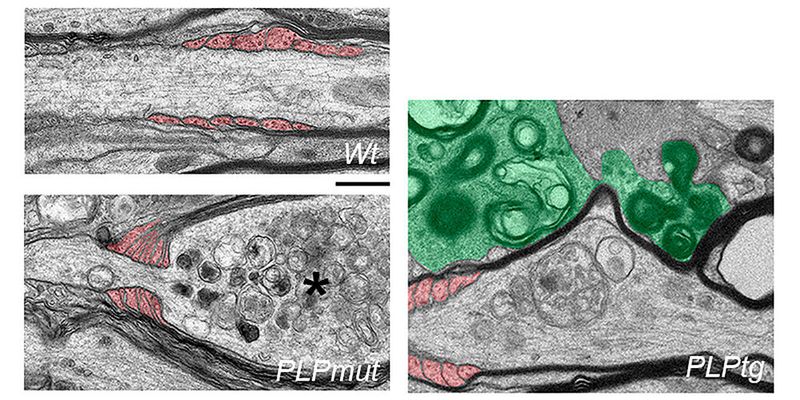 Elektronenmikroskopische Aufnahmen von Axonen in der weißen Substanz von gesunden Kontroll-Mäusen (links oben) und von Mäusen mit verschiedenen Myelin-Gendefekten. Axone, die mit abnormem Myelin umwickelt bleiben (links unten), werden von Fortsätzen der Oligodendrozyten (rot gefärbt) eingeschnürt und weisen Merkmale der Degeneration auf (Stern). Im Gegensatz dazu haben Axone, deren Myelin durch Mikroglia (grün gefärbt, rechtes Bild) entfernt wird, eine höhere Chance zu überleben. Größenmaßstab: 0,5 µm.(Bild:  Janos Groh, © Springer Nature)
