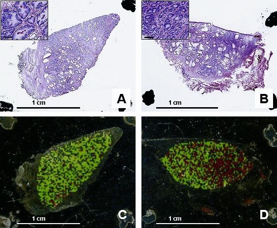 1		Histologische Untersuchungen von Hämatoxilin-Eosin (HE) gefärbtem Prostatagewebe: gesund (A, C) und mit karzinomatösen Regionen (B, D); Bar = 1 cm. C, D: grün entspricht normalem Gewebe, rot: karzinomatösem Gewebe; die ungefärbten Bereiche sind nicht klassifiziert. Die HE-Färbung wurde nach Massenspektrometrie und Elimination der Matrix durchgeführt. (Archiv: Vogel Business Media)