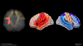 When a stroke damages brain tissue (red) along an important movement pathway (yellow), the injured side of the brain may show faster aging (red), while parts of the opposite side may appear relatively “younger” (blue) as the brain tries to compensate. This pattern is linked to more severe movement problems and less recovery.
 (Bild: Stevens INI)